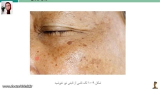 مزوتراپی درمان لک پاکسازی پوست