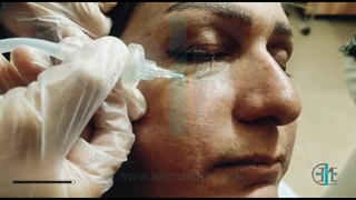 جوانسازی پوست با دستگاه پزشکی Carboxy Therapy