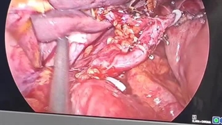 جراحی لاپاراسکوپیک سرطان معده