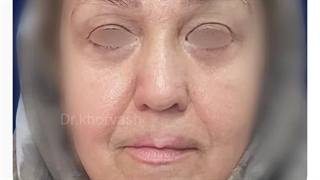 6ماه پس از لیفت آندوسکوپی ابروها و پیشانی و عمل پلک پایین (ترانس کونژ)