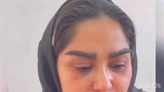 رضایت کاشت ابروی طبیعی بعد از۱۴ روز در مرکز کاشت موی تهران