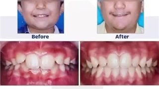 درمان دیپ بایت با ارتودنسی