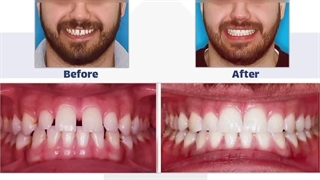 حذف فاصله بین دندان ها با ارتودنسی