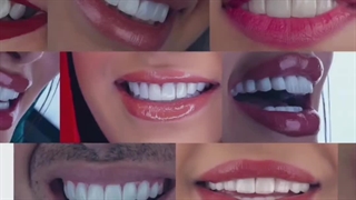 انجام بلیچینگ دندان در کلینیک بارانا