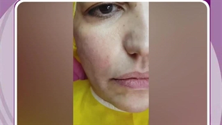 فیلر زیر چشم