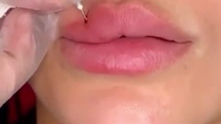 فیلم تزریق ژل لب مدل روسی