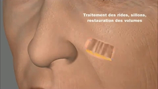 تزریق ژل در کلینیک زیبایی بیوتی لند