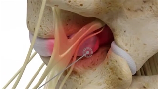 دیسک کمر و کمر درد