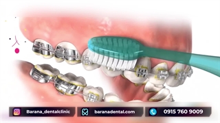 نحوه مسواک زدن با ارتودنسی دندان