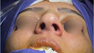 عمل بینی گرد و گوشتی