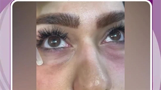 فیلر زیر چشم