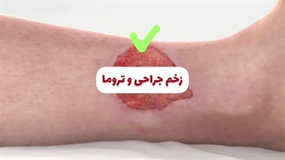 پانسمان آلژینات نقره ملجی زورب مونلیکه