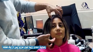 یک هفته بعد از عمل بینی