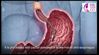 بوتاکس معده