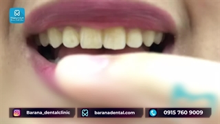 اسنپ ان اسمایل یا لمینت متحرک دندان در مشهد