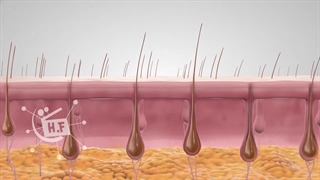 تاثیر لیزر بر ریشه موهای زائد
