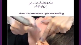 مزونیدلینگ بهتره یا میکرونیدلینگ کلینیک دندانپزشکی