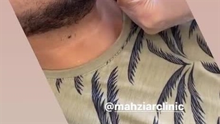 زاویه سازی صورت مردان 2 - کلینیک مهزیار
