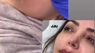 تزریق ژل لب - کلینیک مهزیار