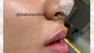 تزریق ژل لب روسی - کلینیک مهزیار