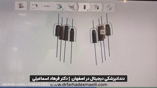 درمان بی دندانی با استفاده از ایمپلنت دیجیتال | دکتر فرهاد اسماعیلی | اصفهان جوانسازی پوست