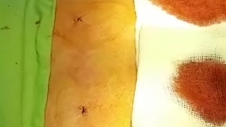 تزریق سلول بنیادین در زانو