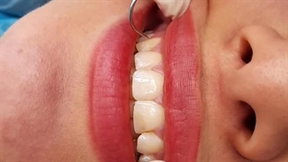 لیفت لثه و آماده شدن دندان برای کامپوزیت