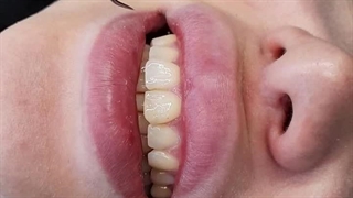 کامپوزیت دندان 8واحد زیبایی در کلینیک آرت دنتال