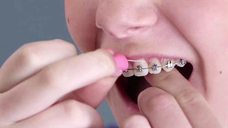 مزیت ارتودنسی نامرئی