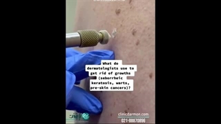 کرایوتراپی و مراحل فریز زگیل تناسلی - کلینیک پایتخت