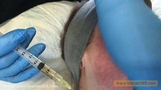 بهترین مرکز مزوتراپی برای رفع ریزش مو در اصفهان کجاست؟