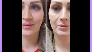 مراقبت‌های بعد از مزوتراپی لک صورت ترمیم لبخند لثه‌ای