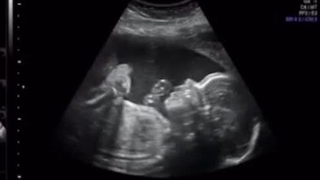 تپش قلب جنین در بارداری