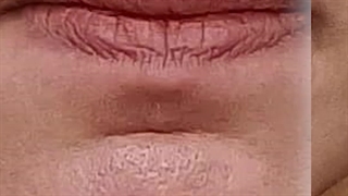 تزریق فیلر لب