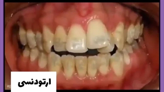 ارتودنسی تک دندان
