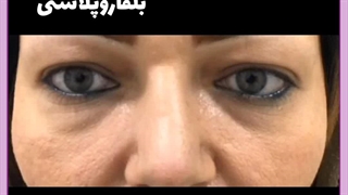 جراحی پلک پایین از داخل چشم