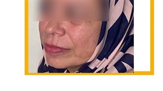 پاکسازی و جوانسازی پوست ترمیم لبخند لثه‌ای