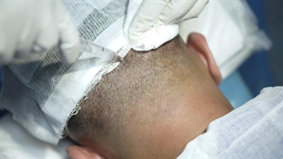 کاشت ریش در کلینیک سلامت ایده آل مشهد