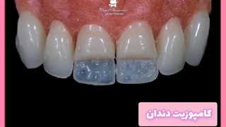 درمان بوی بد دهان بعد از کامپوزیت