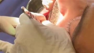 انجام جراحی ایمپلنت