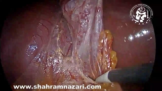 Type IVa Choledochal Cyst