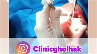 کشیدن دندان و کاشت ایمپلنت همزمان در کلینیک قلهک