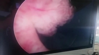 رفلاکس ادراری چیست؟