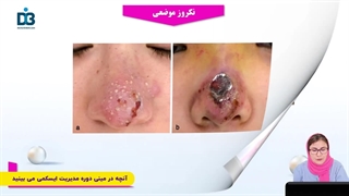 آموزش مدیریت ایسکمی در تزریق فیلر | دکتر بیدکی