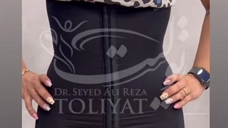 لیپو ۳۶۰ درجه و ابدومینوپلاستی و لیپولیفت ران حدودا یک ماه بعد از عمل