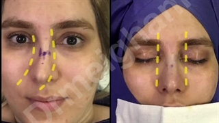 ترمیم انحراف بینی