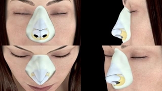 جراحی بینی فانتزی با تکنولوژی پیزوتوم