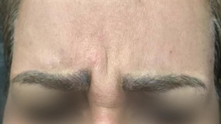 تزریق بوتاکس پیشانی در کرج