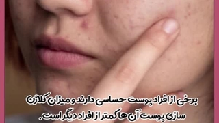 درمان فرورفتگی جای جوش با بهترین روش های خانگی و پزشکی کلینیک دندانپزشکی