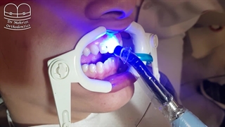 چسباندن براکت های ارتودنسی